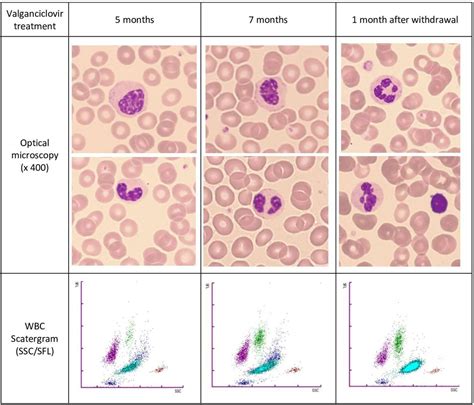 Acquired Pelger-Huët anomaly in a patient treated with valganciclovir | BMJ Case Reports