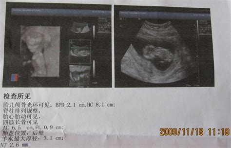 孕13周 B超图，谁能帮我分析一下是男是女？-准妈妈论坛-杭州19楼