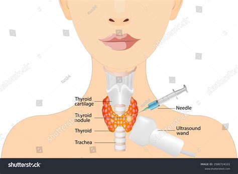 Fine Needle Aspiration Biopsy Thyroid Gland Stock Vector (Royalty Free) 2580724101 | Shutterstock