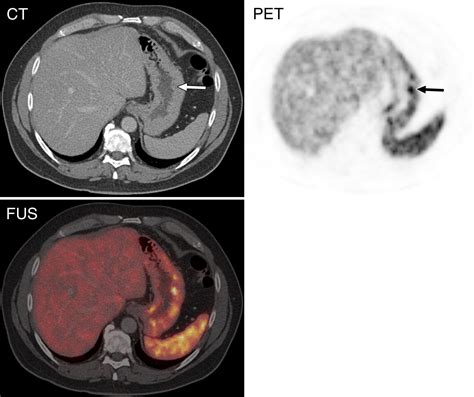 Neuroendocrine Tumor Recurrence: Diagnosis with 68Ga-DOTATATE PET/CTRadiology