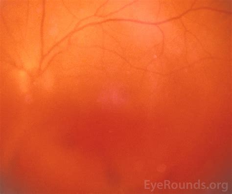 Vitreous Hemorrhage