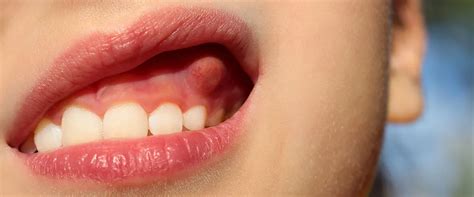 Dental fistulas: Symptoms, causes, treatment | CURAPROX