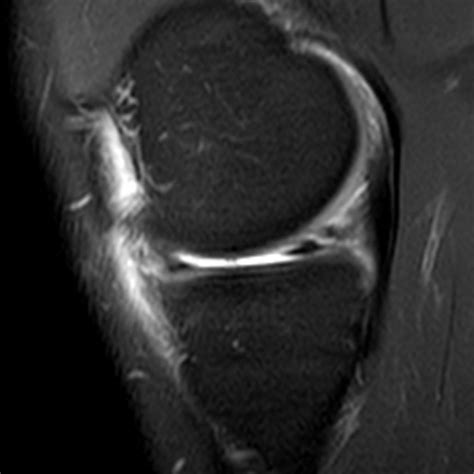 Bucket-handle Tear of the Meniscus - Radsource