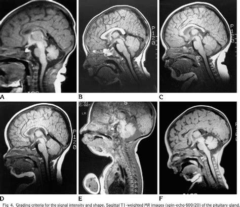 Normal Pituitary Mri T2