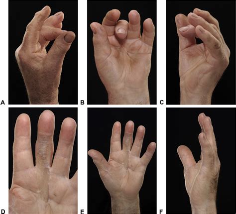 Bildergebnis für dupuytren's surgery pictures