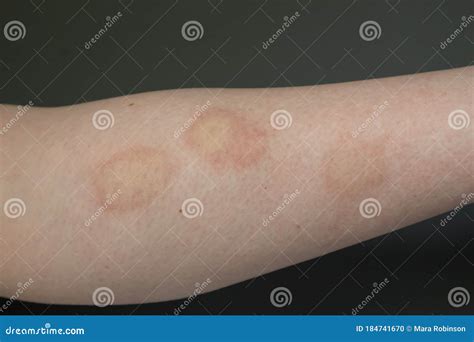 Multiple Inflamed Sore and Swollen Insect Bites Stock Photo - Image of health, body: 184741670