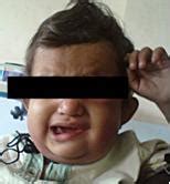 Marginal mandibular nerve palsy as an unusual complication in ludwigs ...