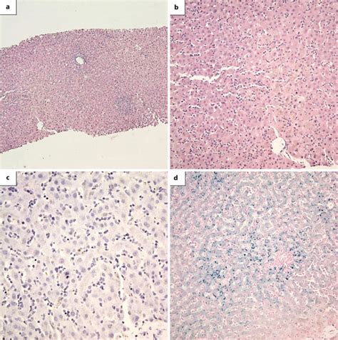 Infectious Mononucleosis Causing Acute Liver Failure and Hemolytic ...