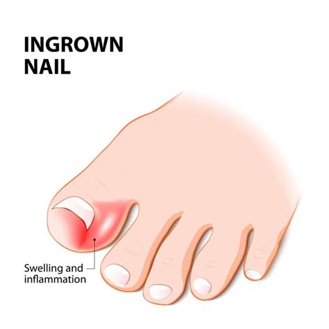 What Is The Fastest Way How To Get Rid Of Ingrown Toenail?