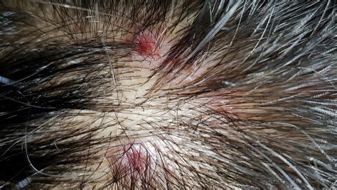 Lichen Planus - New Touch Skin & Hair Care - Blogs