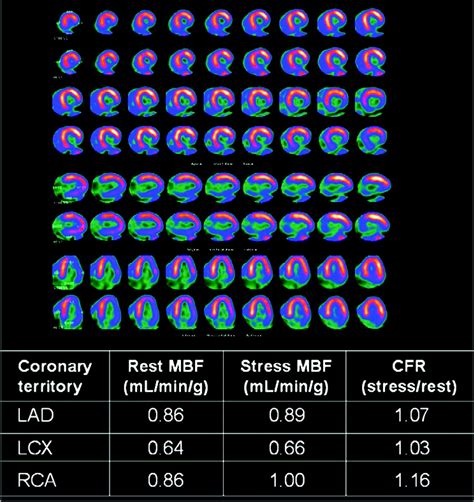 Noninvasive Assessment of Myocardial Perfusion | Circulation ...