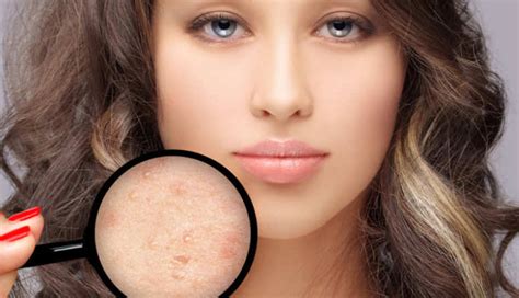 5 Tips To Get Rid of Pimples Quickly - lifeberrys.com