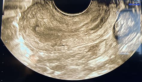 Normal Ovary Ultrasound