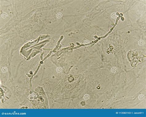 Pseudohyphae and Budding Yeast Cells in Urine Stock Image - Image of ...