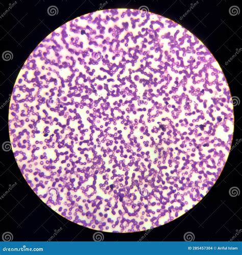 Iron Deficiency Hypochromic Microcytic Anemia, Red Blood Cells Stock Photo - Image of hemolytic ...
