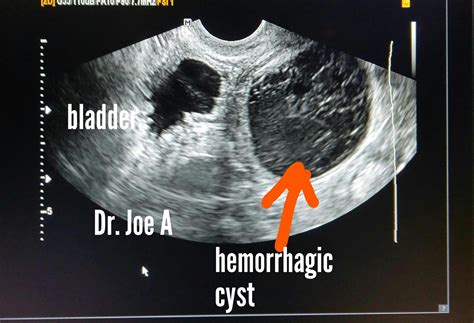 Ultrasound Pictures Of Ovarian Cysts