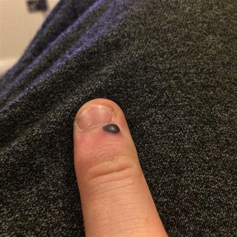 My 1st blood blister! Should I pop it?! : popping
