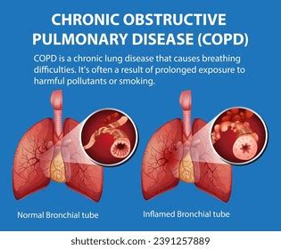 Emphysema Life Expectancy 的图像结果