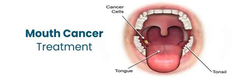 Best Mouth Cancer Treatments at Medicover Hospitals, Nellore