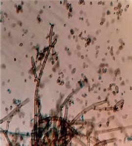 Report of the incidence of a new rare strain of Cladosporium species ...