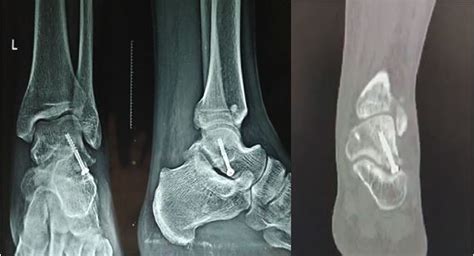 Osteochondritis Dissecans of the Lateral Process of Talus Involving the ...