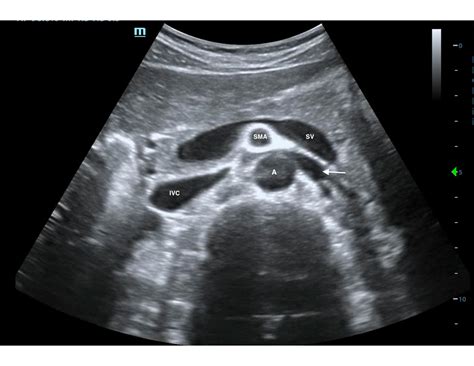 Video: Author Spotlight: Using Point-of-Care Ultrasound for ...