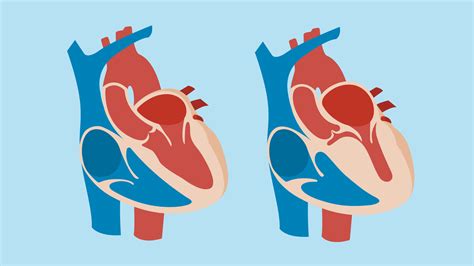 The Treatment of Hypertrophic Cardiomyopathy (HCM): Medication, Surgery ...