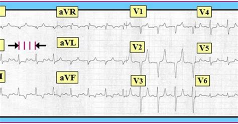 ECG Interpretation: ECG Interpretation Review #10 (Peaked T Waves ...