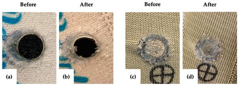 Robotic-Enhanced Prosthetic Liners for Vibration Therapy: Reducing ...