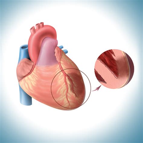 When to use Tirofiban in Acute MI? | FAQ answered by Dr. Viveka Kumar