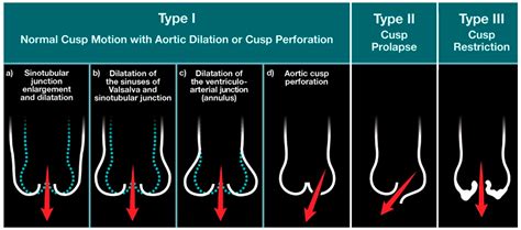 Contemporary Evaluation and Clinical Treatment Options for Aortic Regurgitation
