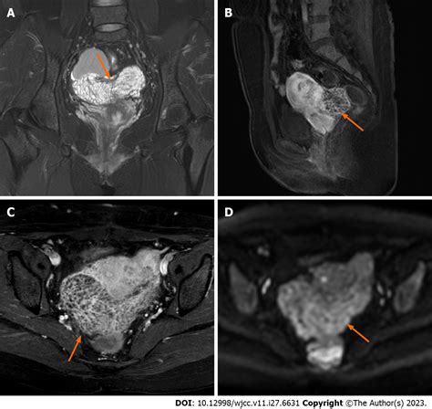 Rapidly growing extensive polypoid endometriosis after gonadotropin-releasing hormone agonist ...