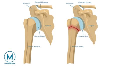 Proximal Humerus Fractures - Kyle McClintock, DO | Orthopedic Surgeon ...