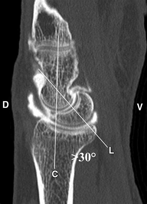 Scapholunate Advanced Collapse and Scaphoid Nonunion Advanced Collapse: MDCT Arthrography ...