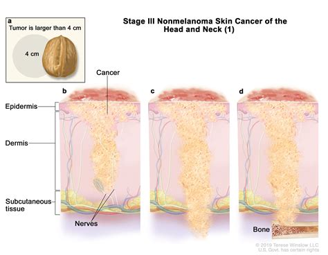 Melanoma Skin Cancer Stages