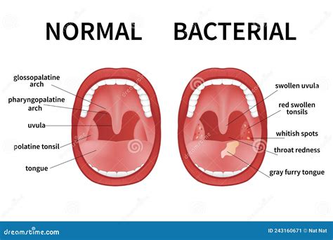 Pharyngitis