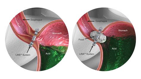 Image result for Linx Reflux Management System