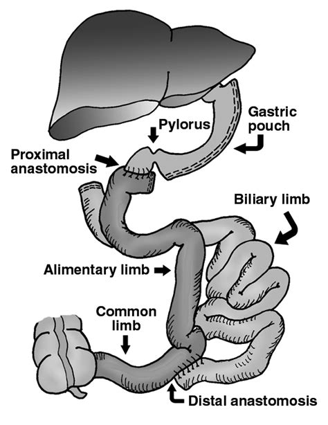 Duodenal Switch Gastric Bypass Surgery for Morbid Obesity: Imaging of Postsurgical Anatomy and ...
