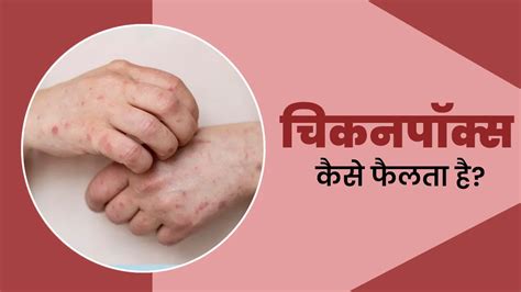 चिकन पॉक्स कैसे फैलता है और कब तक संक्रामक रह सकता है | How is ...