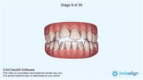 Image result for Invisalign ClinCheck