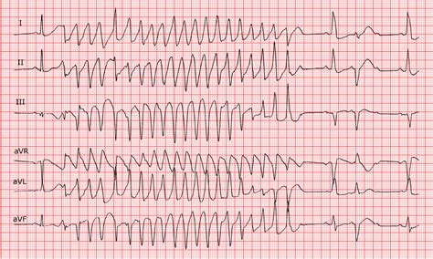 Torsades De Pointes