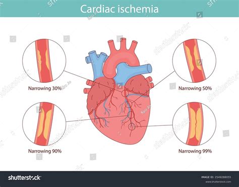 Cardiac Ischemia Anatomical Illustration Drawn Cartoon Stock Vector (Royalty Free) 2549288055 ...