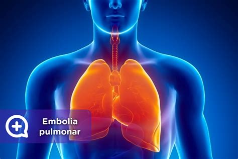 Embolia Signos Y Síntomas , Embolia: síntomas y tratamiento – HZYCT