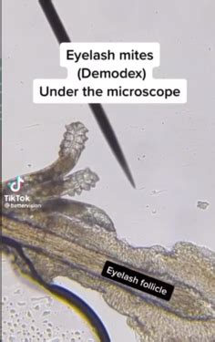 Take The Online Demodex Test To Estimate Your Demodex Mite P - Health ...