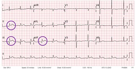 Handheld 6-Lead ECG for Early Detection of Acute Inferior Wall ST-T ...