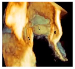 Multimodality Imaging of the Anatomy of the Aortic Root