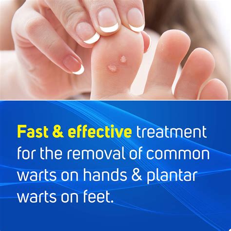 Plantar Wart Removal Singapore Polyclinic at Jett Embling blog