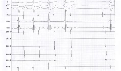 Basic principles of EP maneuvers. Resetting / entrainment