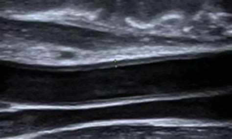 Early treatment with statin reduces CV morbidity in Familial ...