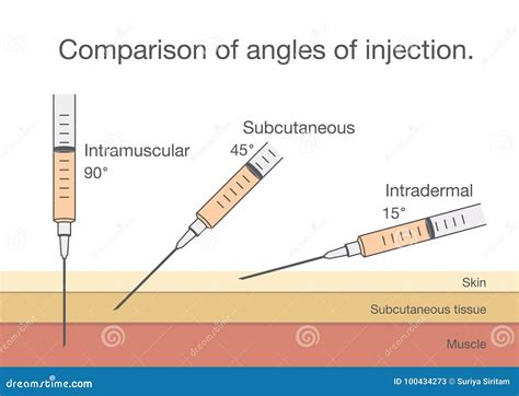 Comparison of the Angles of Intramuscular Injection. Stock Vector ...